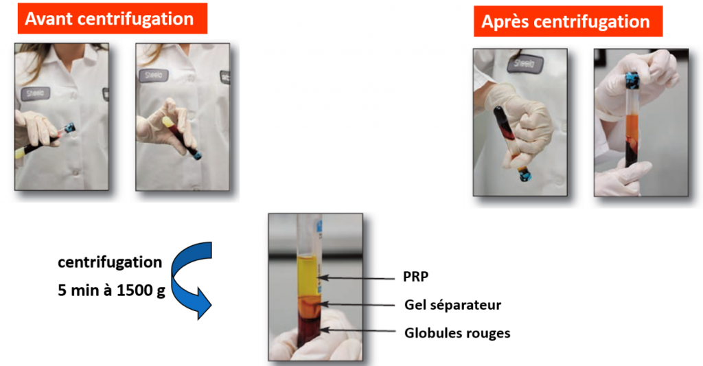 Le PRP, Plasma Riche en Plaquettes | Professeur Hersant à Créteil